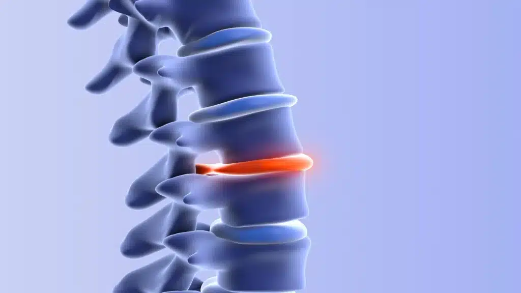 A chiropractor in Queens, NY, providing safe spinal adjustment for a herniated disc after a car accident at Bayside Physical Therapy, Chiropractic & Acupuncture, PLLC.